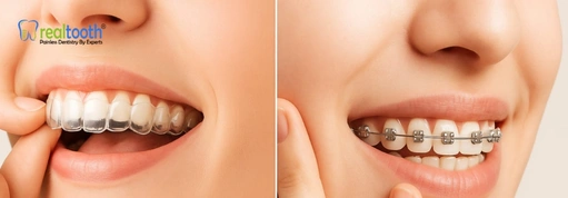 Appearance comparison between clear aligners and traditional braces