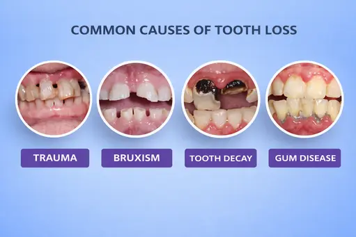 Common causes of tooth loss