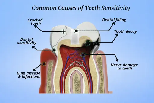 Common dental problems like cavities gum disease and tooth sensitivity