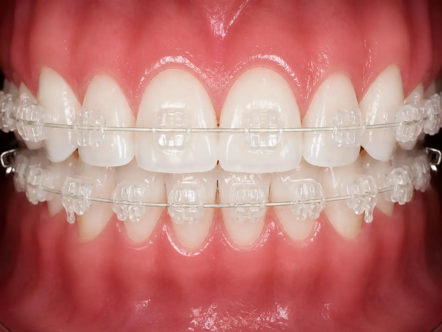 Ceramic braces with clear tooth-colored brackets for less visible teeth straightening