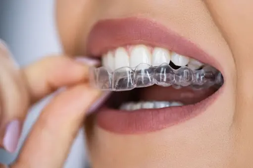 Clear invisible aligners for teeth straightening in Delhi