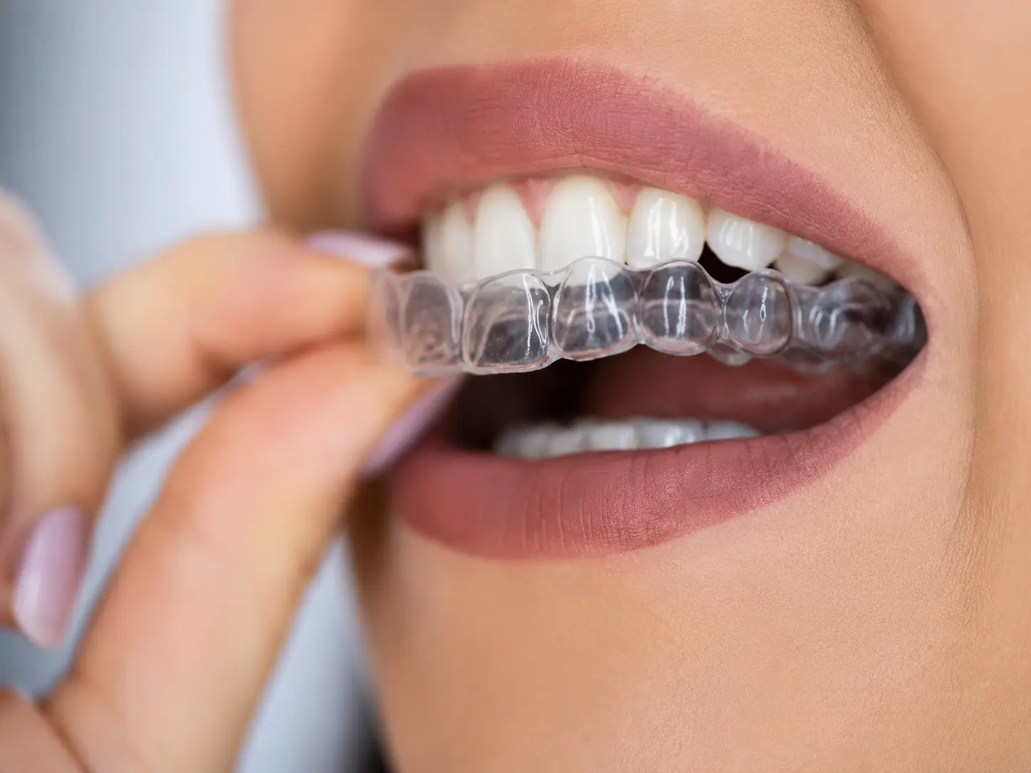 Clear aligner tray being placed over teeth for invisible orthodontic treatment
