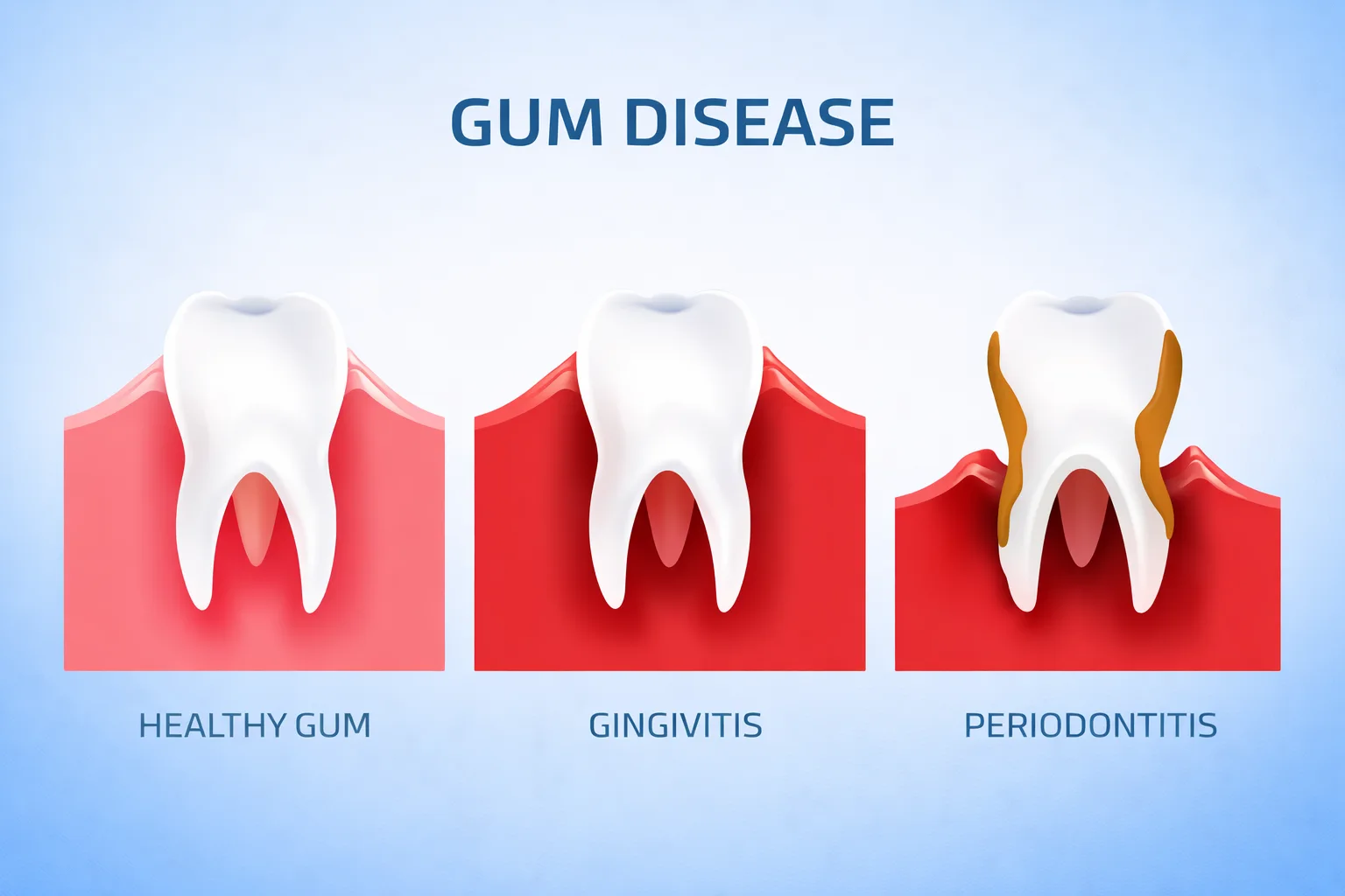 Gingivitis and periodontitis stages causing bleeding gums