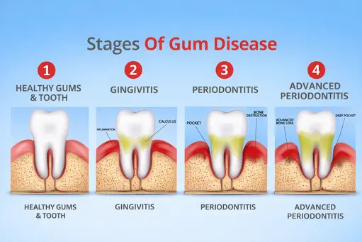 Stages of gum disease from gingivitis to periodontitis