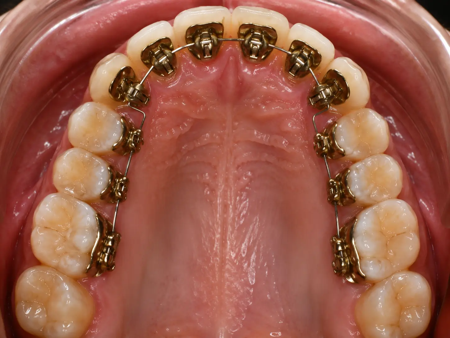 Lingual braces placed on the inside of the upper teeth, hidden from view