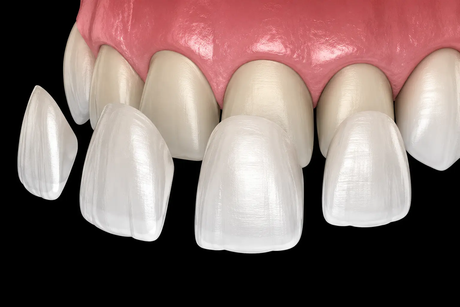 Individual thin porcelain veneer shells positioned in front of natural teeth before placement