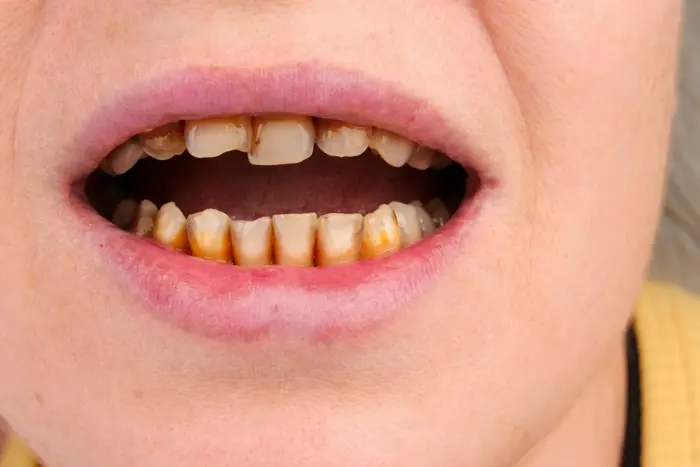 smoking effect on teeth gums