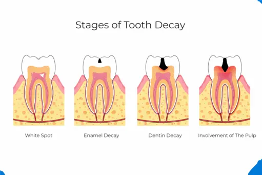 Stages of tooth decay progression