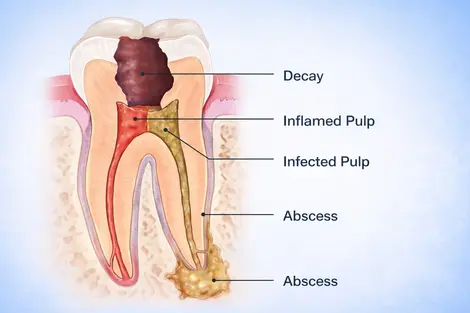 Root canal treatment myths vs facts pain truth and benefits