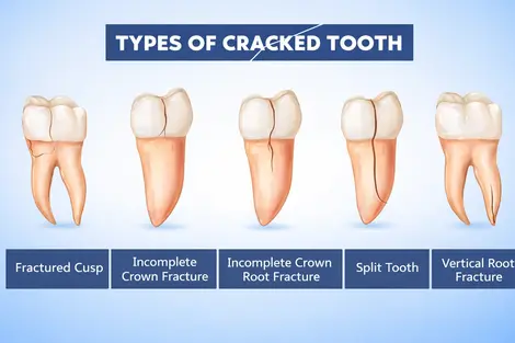 Types of tooth fractures cracks causes symptoms and treatment options