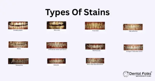 Types of tooth stains and discoloration
