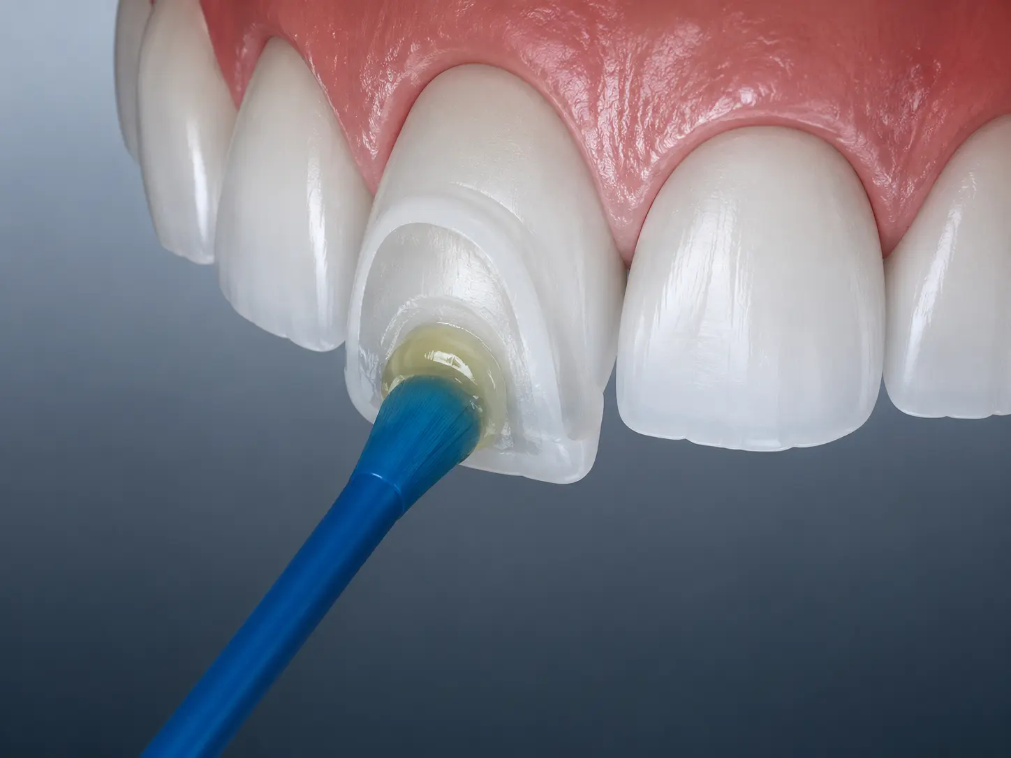 Dental adhesive being applied to tooth surface during veneer bonding procedure