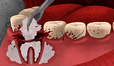 Affordable Dental Bone Grafting in Ramesh Nagar Delhi