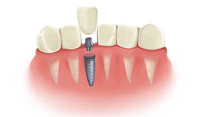 Single Tooth Implants services in Ramesh Nagar Delhi